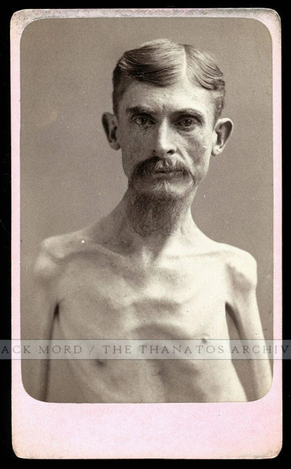 Unpublished Eisenmann Test Shot Ultra Rare CDV Photo Skeleton Man Antique Unpublished Eisenmann Test Shot Ultra Rare CDV Photo Skeleton Man Antique